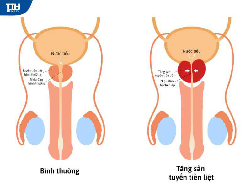 Chẩn đoán tăng sinh tiền liệt tuyến