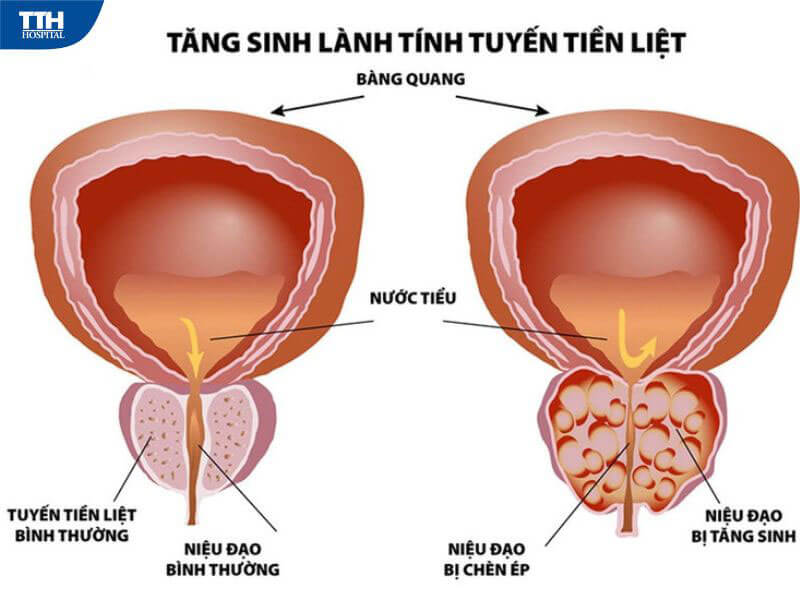 Tăng sinh lành tính tuyến tiền liệt là gì?