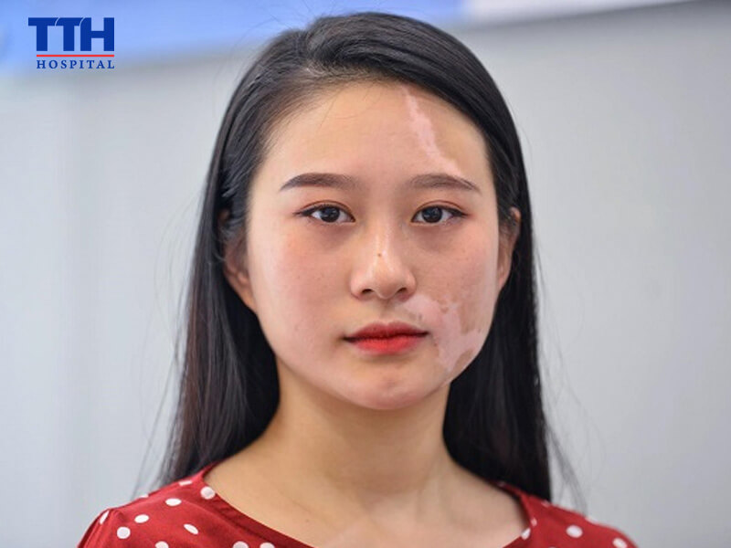 Bệnh bạch biến là gì?