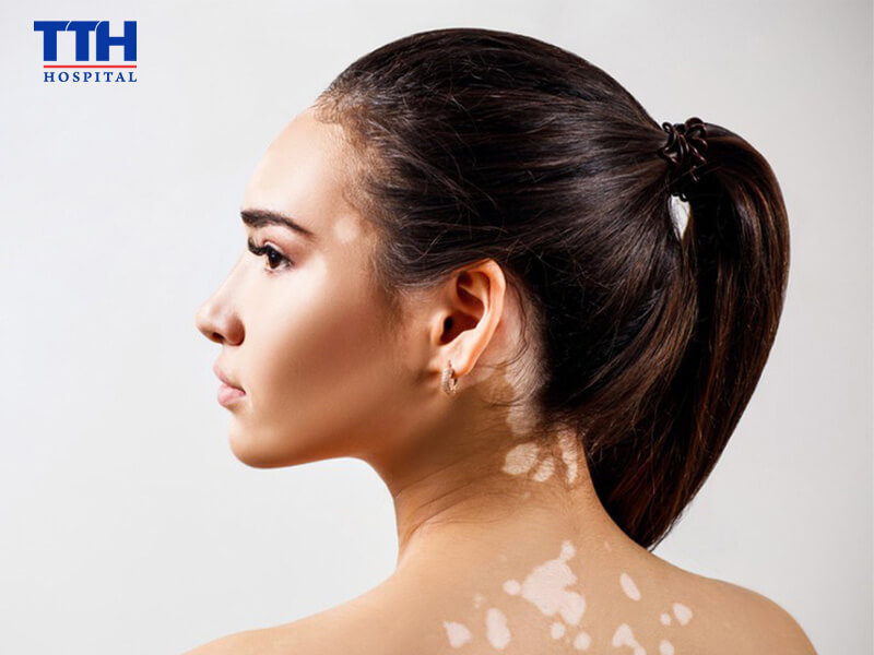 Biện pháp phòng ngừa và chăm sóc tại nhà