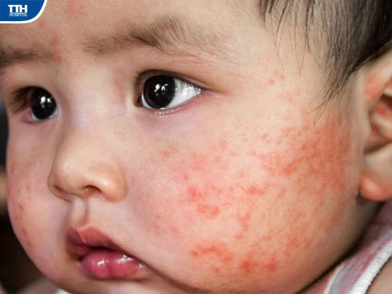 Các loại viêm da thường gặp ở trẻ nhỏ
