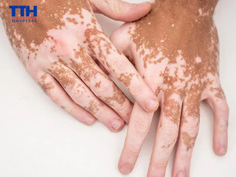 Cách chẩn đoán và phát hiện sớm