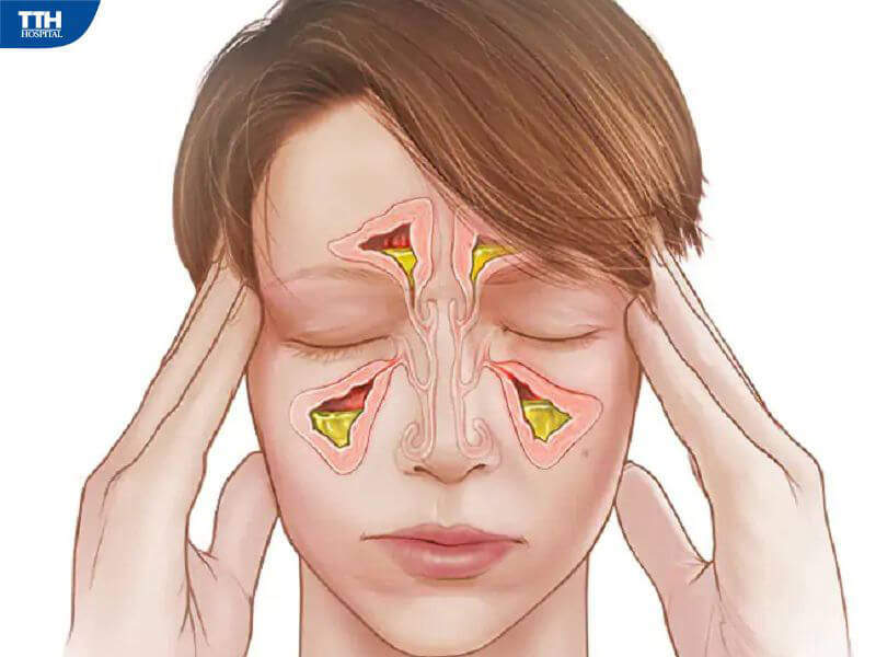 Cách chữa trị viêm xoang