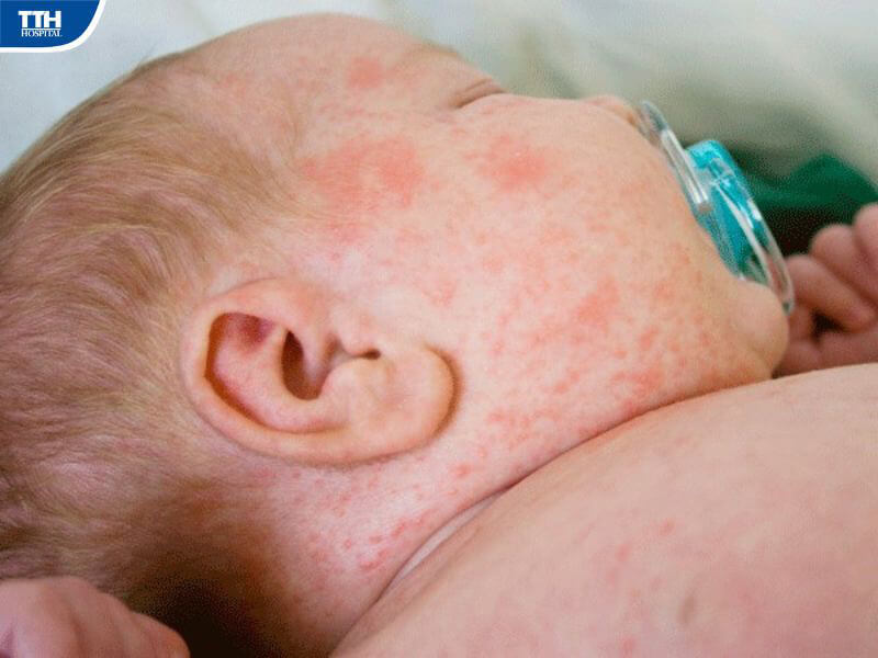 Cách điều trị viêm da ở trẻ