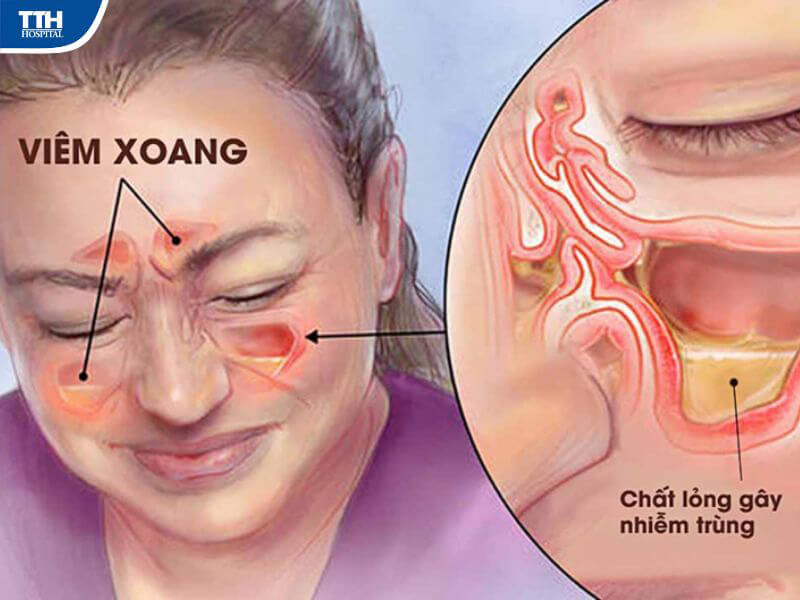 Cách phòng ngừa tái phát sau điều trị
