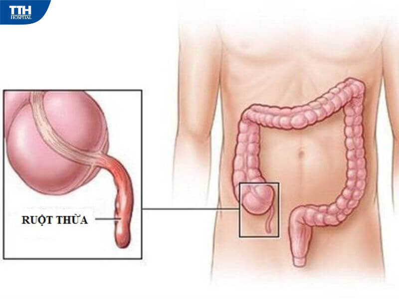 Chẩn đoán và điều trị viêm ruột thừa cấp