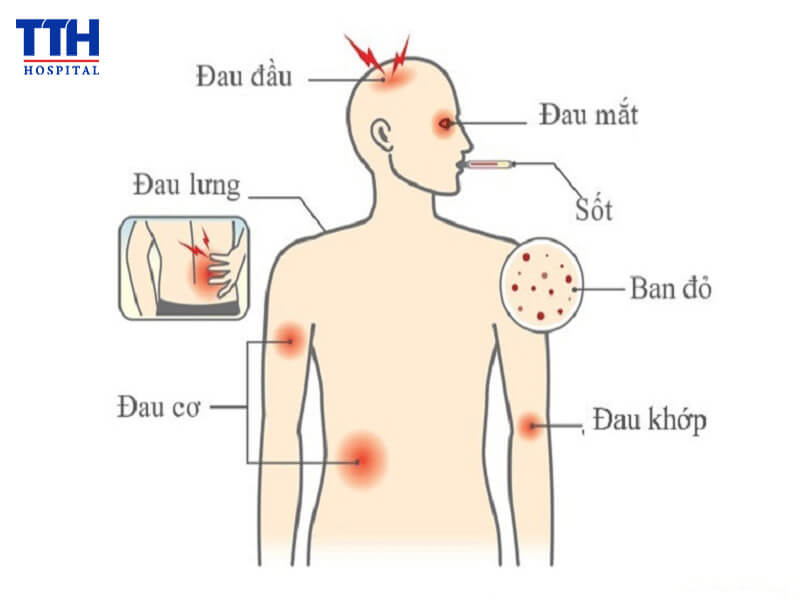 DẤU HIỆU CẢNH BÁO SỐT XUẤT HUYẾT