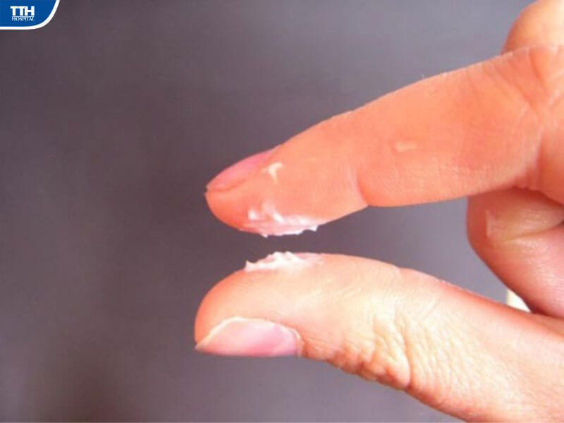 Dấu hiệu nhận biết viêm nấm Candida
