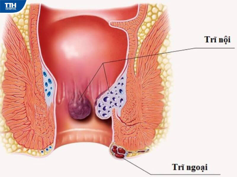 Điều trị bệnh trĩ bằng cách nào?