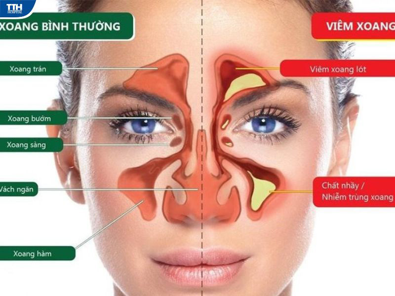 Nguyên nhân gây bệnh viêm mũi xoang