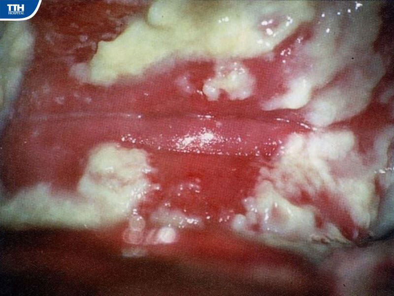 Phòng ngừa viêm âm đạo do nấm Candida bằng cách nào?