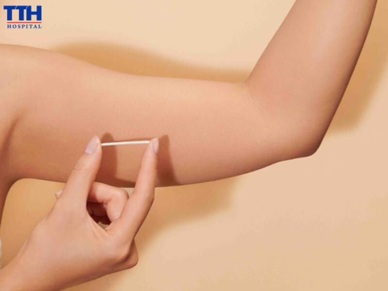 Phụ nữ nên tìm hiểu những đối tượng nên và không nên cấy que Implanon