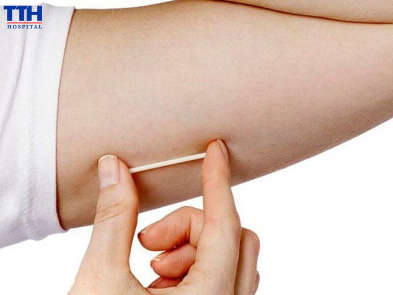 Phương pháp cấy que Implanon là một trong những phương pháp hiệu quả, mang lại an toàn