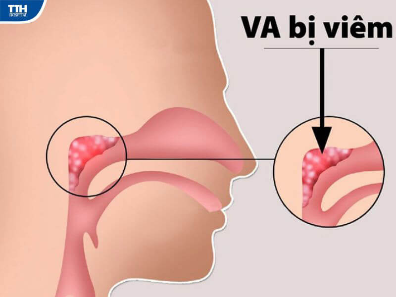 Phương pháp điều trị viêm VA, viêm amidan quá phát ở trẻ