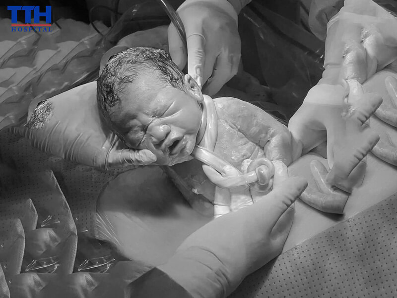 Thành công với ca sinh thai nhi bị dây rốn quấn cổ 3 vòng