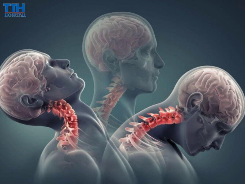 Thoái hóa cột sống cổ là gì?