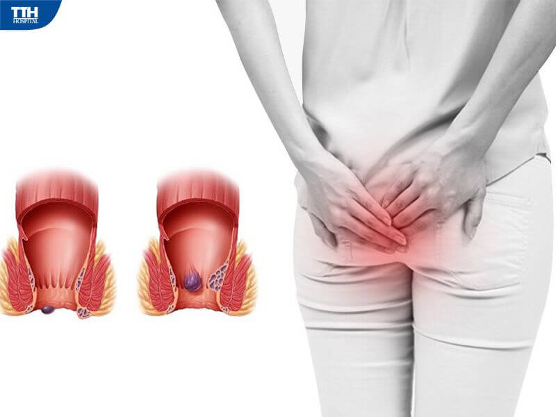 Triệu chứng của bệnh trĩ