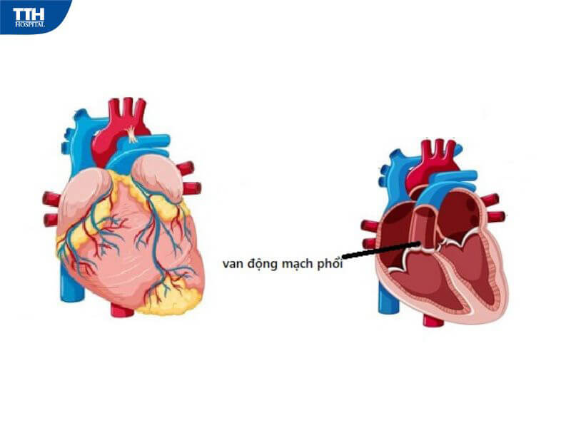 Triệu chứng nhận biết người bị hở van động mạch phổi