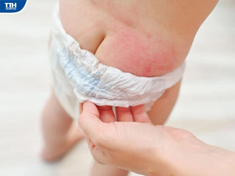 Viêm da ở trẻ là gì?