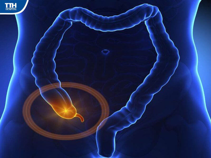 Viêm ruột thừa cấp là gì?