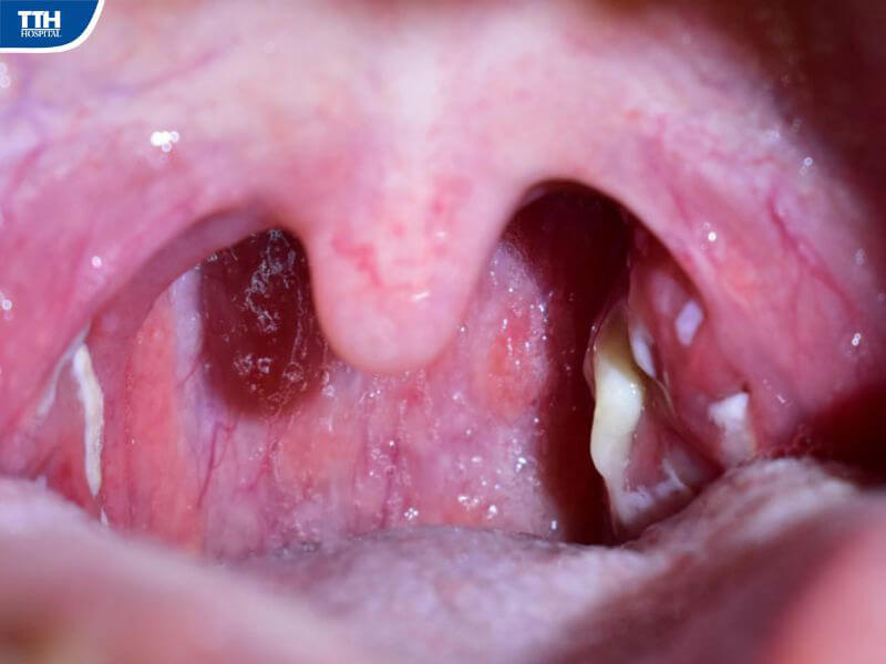 Viêm VA, viêm amidan quá phát ở trẻ gây ra những biến chứng gì?
