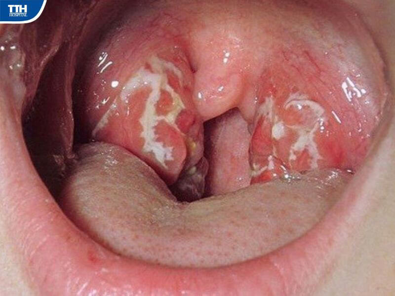  Viêm VA, viêm amidan quá phát ở trẻ là gì?
