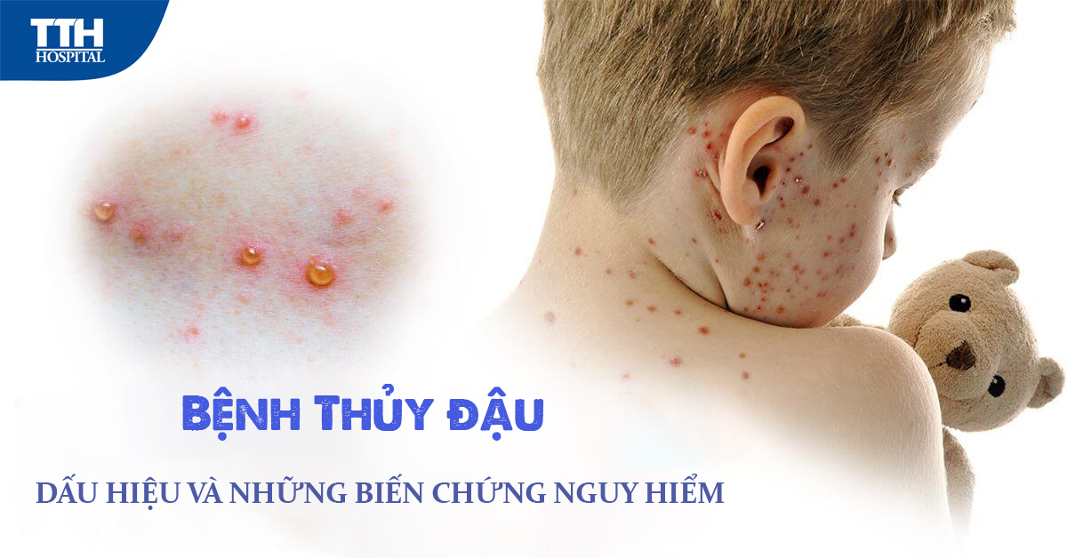 Bệnh thủy đậu và những điều cần lưu ý để bảo vệ con trẻ