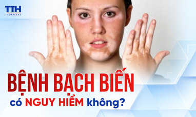 Bệnh bạch biến có nguy hiểm không?