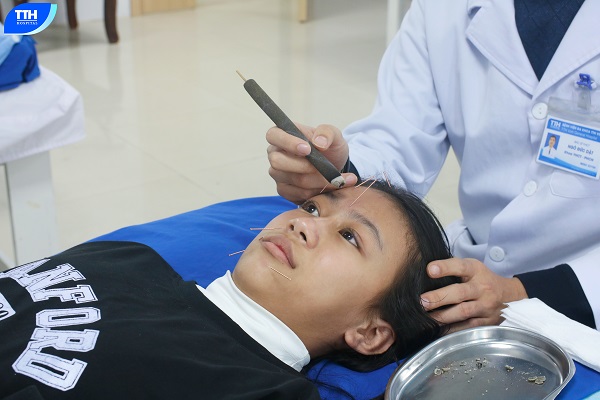 Phục hồi chức năng liệt dây thần kinh VII ngoại biên