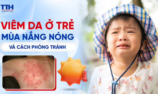 VIÊM DA Ở TRẺ VÀ CÁCH PHÒNG TRÁNH BỆNH VIÊM DA