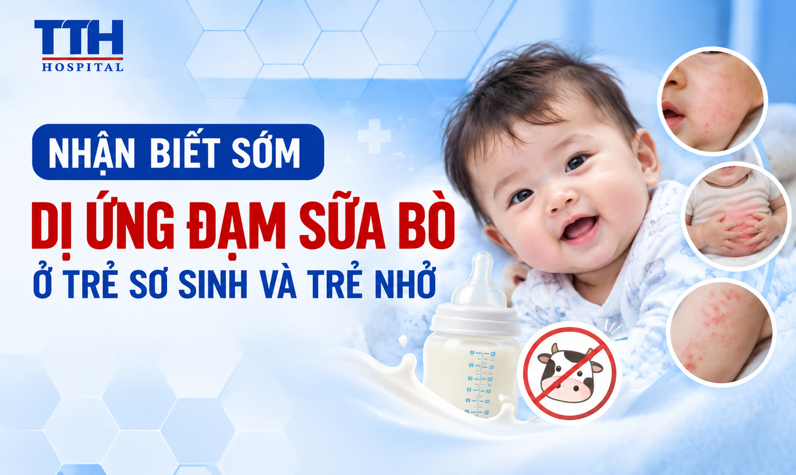 NHẬN BIẾT SỚM DỊ ỨNG ĐẠM SỮA BÒ Ở TRẺ SƠ SINH VÀ TRẺ NHỎ