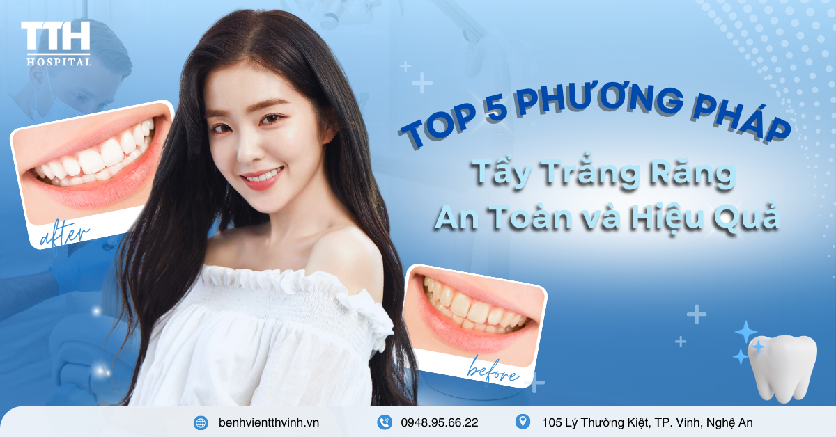 Top 5 Phương Pháp Tẩy Trắng Răng An Toàn và Hiệu Quả